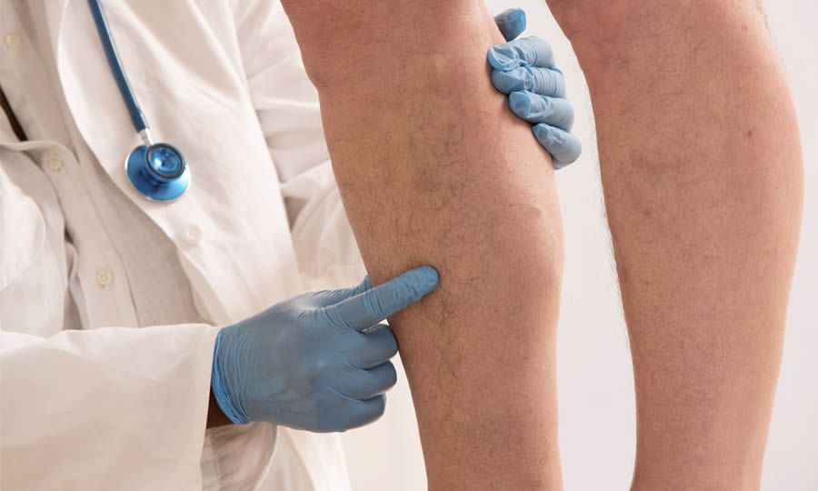 Vascular Disease